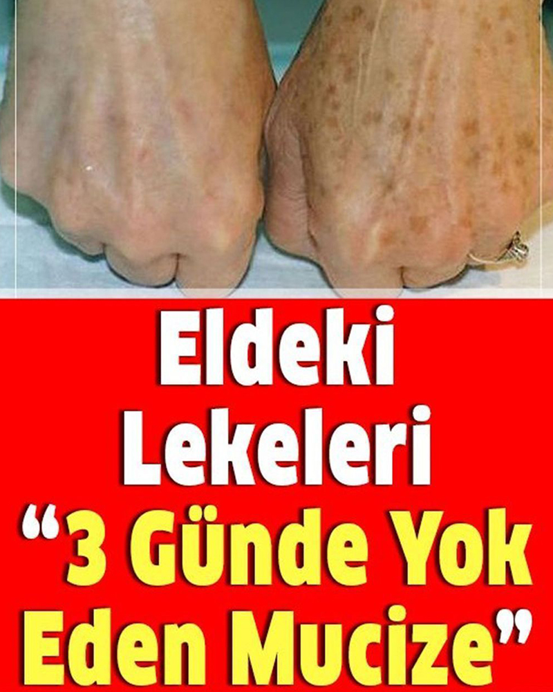Eldeki lekeleri 3 günde yok eden mucize