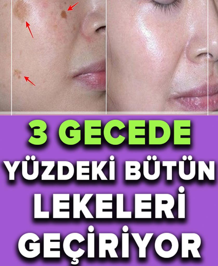 İki Malzemeli Bu Tarif Yüzünüzdeki Lekeleri 3 Gecede Geçiriyor
