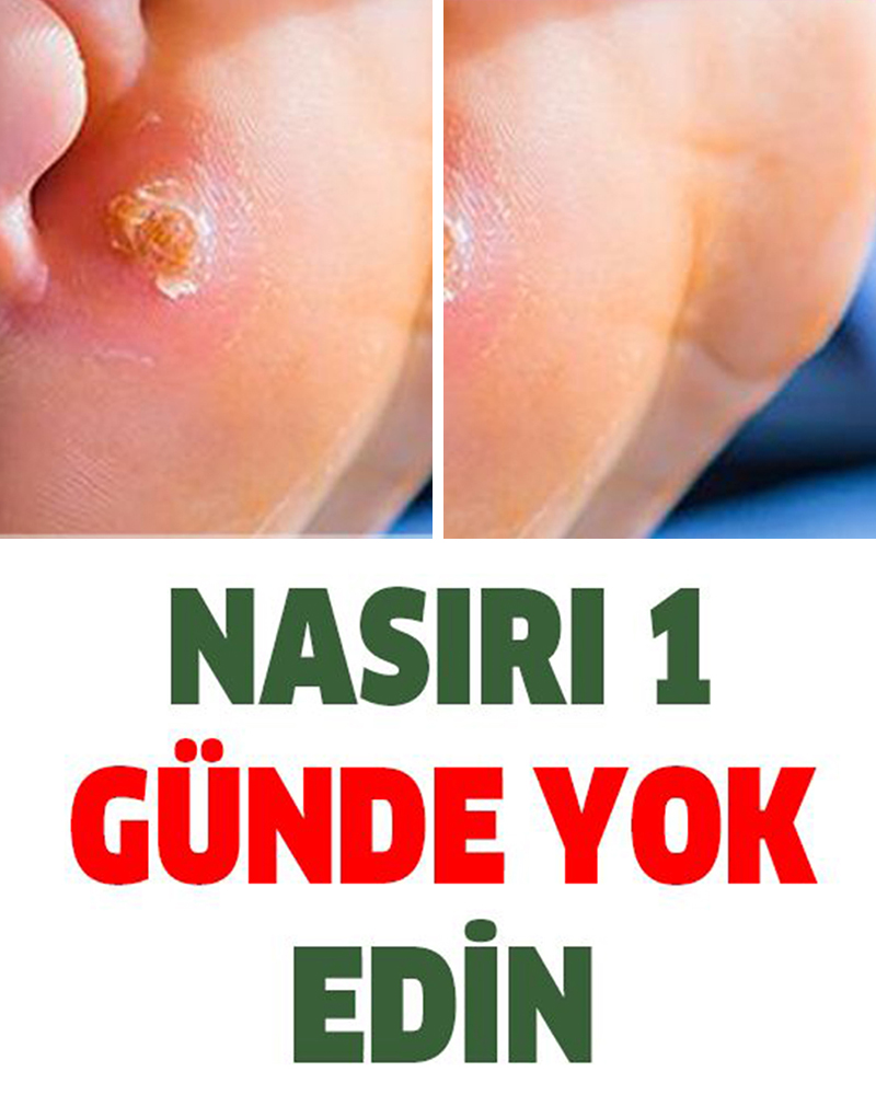 İşte Nasırdan 1 Günde Kurtaracak Doğal Tedavi Yöntemleri
