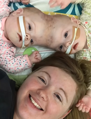 İkizlerin Başarı Hikayesi: Tıbbı Zorluklara Rağmen Anaokulunu Bitirdiler