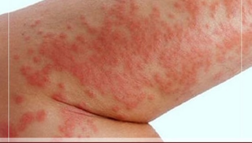 Yıllarca Çare Aradı, Çözümü Market Rafında Buldu