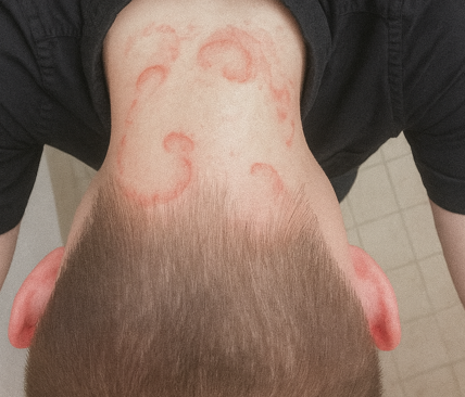 Oğlumun kafasında ve ensesinde kızarıklar gördüm