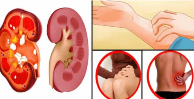 Böbrek Kanserinin Bu Belirtilerine Dikkat!!