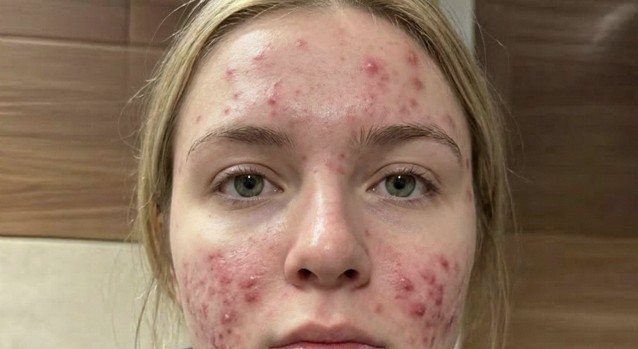 Çenenizde Sürekli Sivilce Çıkmasının Gizli Sebepleri!