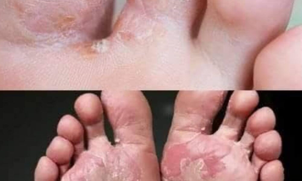 Uyarı: Eğer ayaklarınızda bu varsa, gizli diyabet belirtisi olabilir, dikkatli olun