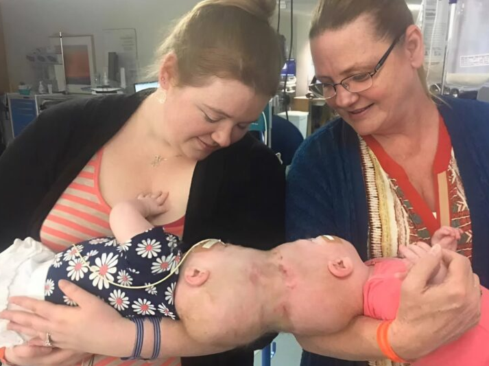 Siamese ikiz kız kardeşler başları yapışık olarak doğdu, ancak 1 yaşındayken doktorlar onları ayırdı: Kızların bugünkü hali şöyle